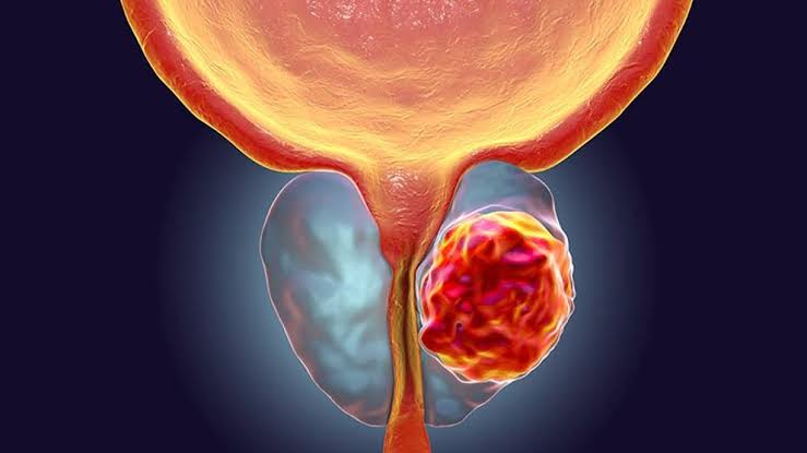 prostata imagem essa Nova técnica não invasiva de tratamento do câncer de próstata usa ondas sonoras para destruir tumores