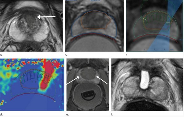 prostata imagem Nova técnica não invasiva de tratamento do câncer de próstata usa ondas sonoras para destruir tumores