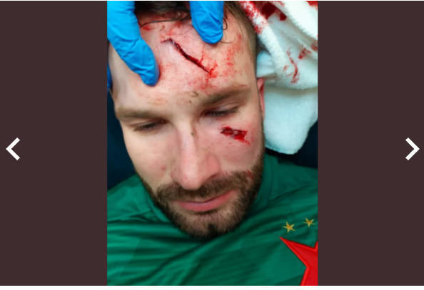 imagem forte Imagem forte: voadora de atleta do Rangers faz rombo no rosto de rival